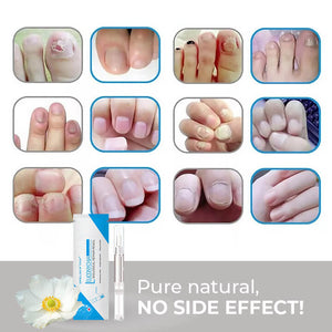 Anti-Fungal Treatment Pen - Safe, Easy, and Fast Nail Treatment